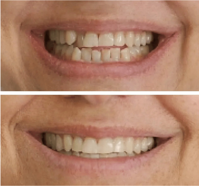 Clear aligners Before & After Our Patients Speak For Us Eon Aligner